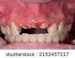 Small photo of Dentistry clinic case of a patient with oral disease located in the central incisor because of dental decay and bad hygiene. Broken teeth located in the anterior sector with aesthetic problem.