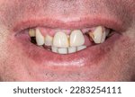 Small photo of Frontal view of a man mouth smiling with badly made fake teeth with cheap resin material fixed prosthetic dental crowns in central incisors. Broken decayed lateral incisor and bad hygiene.
