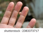 Small photo of Finger wart on hand. Health concept. body wart