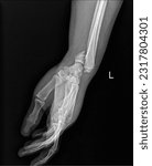 Small photo of x-ray image show fracture radius ulna bone
