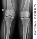 Small photo of X-ray of the human knee joint, capturing the femur, tibia, patella, and menisci, assisting in diagnosing knee injuries and degenerative changes