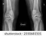 Knee Arthritis X-Ray - Key Imaging for Evaluating Joint Damage and Diagnosing Osteoarthritis Progression