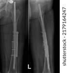 Small photo of x-ray of the pen Fracture of the femur. Femur fracture is a fracture of the femur, which is the longest, strongest, and heaviest bone in the human body