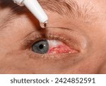 Small photo of Moisturizing drops instilled into the eye from close up, red, irritated eyes