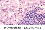 Small photo of Microscopic image (photomicrograph) of a poorly differentiated gastric mucinous adenocarcinoma (stomach cancer), signet ring cell type, with metastasis to regional lymph node.