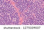 Small photo of Lymphoma awareness: photomicrograph of a mantle cell lymphoma, a type of non-Hodgkin B-cell lymphoma.