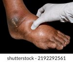 Small photo of Pitting edema of lower limb. Swollen leg of Asian old man.