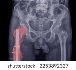 Small photo of X-ray image of a hip fracture of the femur Open Reduction Internal Fixation with the bone axis. by an orthopedic surgeon
