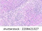 Small photo of Histology of bovine heart, myocarditis pathology