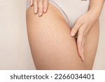 Small photo of Stretch marks on female legs. A woman's hand holds a fat cellulite and a stretch mark on her leg. Cellulite.