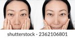 Small photo of Asian close up woman happy face before after cosmetic procedures. Skin care wrinkled face, dark circles under eyes. Before-after anti-aging face lift treatment. Facial skincare, beauty contouring