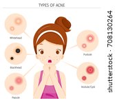 acne types and girl with acne... | Shutterstock .eps vector #708130264
