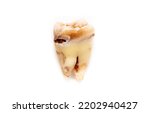 Small photo of Close-up of a tooth with caries isolated on a white background. Removed wisdom teeth. Sick human teeth.