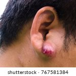 Small photo of Close up of abscess Inflammation on the ear, area of suppuration. Collection of pus that has built up within the tissue of the body.
