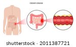 crohns disease concept.... | Shutterstock .eps vector #2011387721