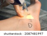 Small photo of Laser removing of tattoo with words loser, lover and heart on woman's foot in red and black colours, closeup hands of doctor in gloves. Romantic tattoo symbol of youth love and disappointment in life.