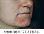 Small photo of Perioral dermatitis on woman face. Closeup dermatitis on skin, ill allergic rash eczema skin of patient, atopic dermatitis symptom skin detail texture. The concept dermatology