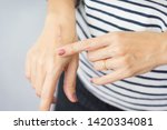 Small photo of Close up: First degree heat burn scar on a woman's hand. The wound damage on epidermis outermost layer of skin. Healing, Removal, Treatment, Accident in the kitchen, Scar, Scald, Wound Healing, Repair