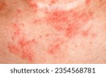 Small photo of Eczema (Atopic Dermatitis): Eczema is a chronic inflammatory condition characterized by red, itchy, and inflamed skin. It often appears as patches on the skin that can be dry, scaly, and may even ooze