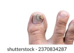 Small photo of onychomycosis concept.Nail infections caused by fungi such as: onychomycosis also known as tinea unguium. Thumb infection. Caused by dermatophytes and yeasts and concomitant antibacterial activity
