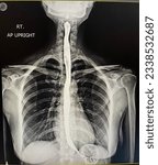 Small photo of "barium swallow" X-ray while the patient is swallowing powder shows the esophagus as the powder is being swallowed all the way down to the stomach.