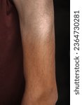 Small photo of Asian man arm tanned, tan arms, sun burn marks, tanned body, black and white arm, due to half sleeve t-shirt in sunny day, half tan body and hand, tanning, sun burn, sunburned, arm illness, arms. Hand