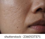 Small photo of Close-up view of the middle-aged woman with big pores, acne-prone skin and smile lines, or laugh lines, noticeable between noses and around the mouth