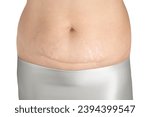 Small photo of Caesarean section surgical scar on a white background