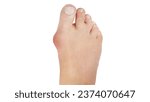 Small photo of Bunions are bony protrusions at the base of the big toe, causing it to deviate towards the other toes, often leading to pain and discomfort.