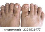 Small photo of Closeup inflammation of deform bunion joint in big toe bone. Hallux valgus, bunion in female foot compare with typical foot isolated on white background.