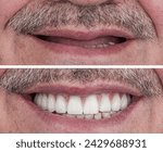 Porcelain dental prosthesis placed on implants. All-on-Four treatment.