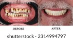 Small photo of Comparative collage Before and After. Installation of veneers. Chronic generalized Paradontitis. Severe Gum disease. Dentist office. Wedge-shaped defect. Smoker plaque