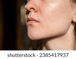 The woman skin flakes off at the mouth. Dry skin. Face skin irritation after peeling, after cold windy weather. Dark background, side view