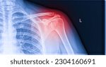 X ray image of shoulder pain ...