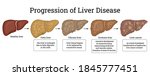 stages of liver damage such as... | Shutterstock .eps vector #1845777451