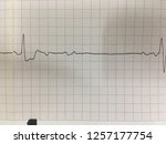 Small photo of Ecg showinh heartbeat with heart block disease