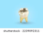 Small photo of Macro of a tooth containing amalgam. Dental caries and Dental cavity with calculus. light blue background . Front side view . Tooth decay and tooth decay begins to decay.