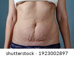 Abdominal skin of a woman with stretch marks after childbirth