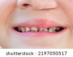 A child shows his crooked teeth. Above the lip is a scar from an operation. Rotated cleft palate pathology
