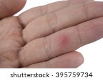 Finger With Splinter Isolated...