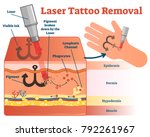laser tattoo removal vector... | Shutterstock .eps vector #792261967
