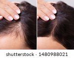 Woman Before And After Hair Loss Treatment