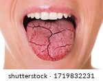 Woman Mouth And Broken Tongue With Cracks