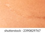 Small photo of Scar on human skin after caesarean section.
