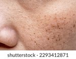 Small photo of Woman's problematic skin pore and dark spots on the face