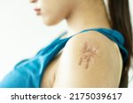 Small photo of Woman having large hypertrophic scar on her left upper arm due to injury or vaccination adverse side effect