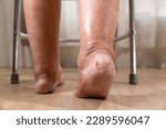 Small photo of Woman's leg is edema (swelling) after cancer treatment.