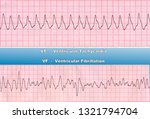 Small photo of Ventricular Tachycardia (VT) - is fast heart rhythm, that originates in one of the ventricles of the heart. Ventricular Fibrillation (VF) - is a cause of cardiac arrest and sudden death.