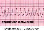 Small photo of Ventricular tachycardia (VT) is a tachycardia, or fast heart rhythm, that originates in one of the ventricles of the heart. This is a potentially life-threatening arrhythmia.
