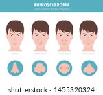 nasal diseases. rhinoscleroma... | Shutterstock .eps vector #1455320324